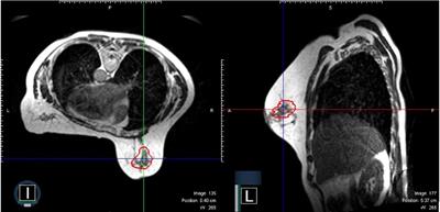 The initial experience of MRI-guided precision prone breast irradiation with daily adaptive planning in treating early stage breast cancer patients